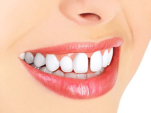 انواع کاشت دندان های رایج (بریج و ایمپلنت)