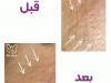 فوتونا فرکشنال یا فوردی؟ جوانسازی بدون جراحی و رفع جای جوش با لیزر فوتونا در مشهد