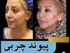 بهترین متخصص تزریق چربی به صورت در تهران کیست؟