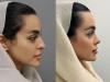 بهترین جراح بینی طبیعی در تهران +معرفی ۱۰ جراحی برتر و نمونه کار