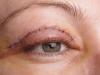 بلفاروپلاستی؛ جراحی برای جوان‌تر شدن چشم‌ها، نه تغییر فرم آن‌ها"