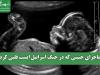 ماجرای جنینی که در جنگ اسرائیل ایست قلبی کرد