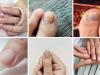 ۷ علامت هشداردهنده کلسترول بالا در ناخن کدامند؟