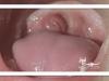 چرا توجه به لوزه سوم اهمیت دارد؟