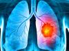 درمان تغییرات ایجادشده در میکروبیوم ریه بر اثر سیگار کشیدن