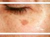 چرا تشخیص لک پوستی اهمیت دارد؟