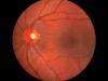 قطره ابداعی محقق ایرانی التهاب چشم را درمان می‌کند