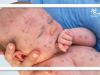 بازگشت سرخک؛ بهای سنگین اعتماد به واکسن‌گریزی و شبه‌علم