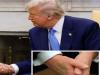 ابتلای ترامپ به «نارسایی مزمن وریدی»