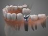 ایمپلنت دندان چیست؟ (بررسی کامل Dental Implant)