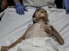 یک کودک دیگر فلسطینی در نتیجه سوء تغذیه جان داد
