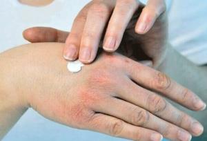 راهکارهای طب ایرانی برای سلامت پوست در فصل سرد