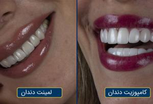 کامپوزیت یا لمینت دندان؟ بررسی تفاوت‌ها، مزایا و انتخاب هوشمندانه