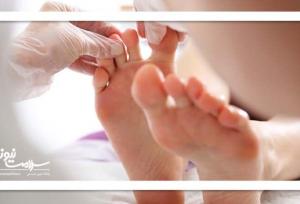 ۱۵ درصد دیابتی‌ها به زخم دیابت مبتلا می‌شوند؛ خطرات و راه‌های پیشگیری