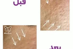 فوتونا فرکشنال یا فوردی؟ جوانسازی بدون جراحی و رفع جای جوش با لیزر فوتونا در مشهد