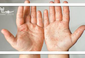 تب برفکی: بیماری‌ ایمن از انتقال به انسان / نظارت‌های دقیق دامپزشکی محصولات آلوده را از بازار خارج می‌کند