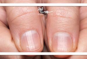 تغییرات هلال ناخن را جدی بگیرید