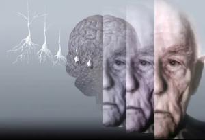 طراحی ابزار هوش مصنوعی برای تشخیص نوع و شدت زوال عقل