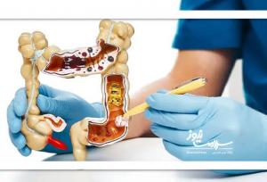 عوامل اصلی رشد سرطان‌های گوارشی در ایران،مصرف الکل و دخانیات متهم شماره یک
