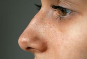 قوز بینی، ترند تازه زیبایی ۲۰۲۶ شد!