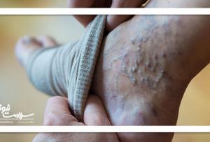 واریس پا: خودمراقبتی و روش‌های خانگی موثر