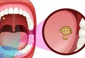 سیگار از مهم‌ترین علل ابتلا به سرطان دهان