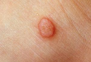 هزینه برداشتن خال گوشتی در سال ۱۴۰۴ چقدر است؟