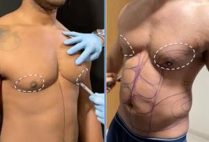 تفاوت ژنیکوماستی و چاقی سینه چیست؟