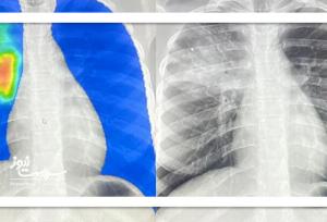 انقلاب هوش مصنوعی در تشخیص سل