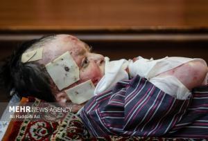 خانواده‌های دارای ازدواج فامیلی بیشتر به بیماری پروانه‌ای مبتلامی‌شوند