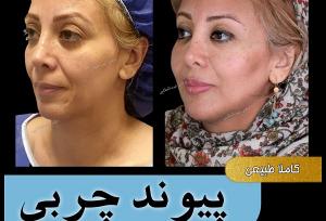 بهترین متخصص تزریق چربی به صورت در تهران کیست؟