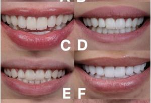 رنگ بندی و کاتالوگ کامپوزیت توکویاما