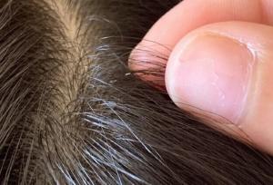 هشدار درباره شیوع شپش سر/ آلودگی به معنای رعایت نکردن بهداشت نیست