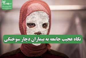 نگاه عجیب جامعه به بیماران دچار سوختگی