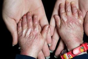 سهمیه تابستان پانسمان‌های تخصصی به خانه EB تحویل شد