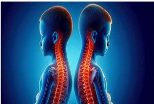 اسکولیوز تهدید خاموش ستون فقرات کودکان است؛ از هر ۲۰ نفر یک مبتلا