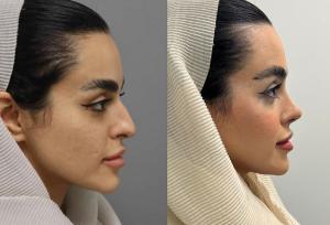 بهترین جراح بینی طبیعی در تهران +معرفی ۱۰ جراحی برتر و نمونه کار