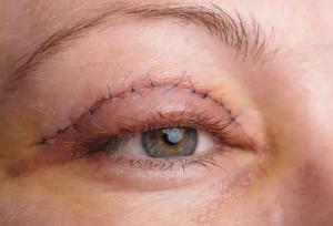 بلفاروپلاستی؛ جراحی برای جوان‌تر شدن چشم‌ها، نه تغییر فرم آن‌ها"