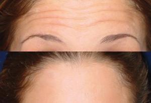 بهترین برندهای بوتاکس برای پیشانی کدامند؟