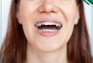 چه زمان به متخصص ارتودنسی مراجعه کنیم؟ ۶ عامل موثر بر آن