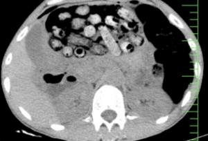 خروج بیش از ۹۰ بسته مواد مخدر از معده و روده یک مرد در کرج