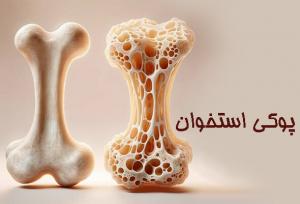 چطور با «پوکی استخوان» مقابله کنیم؟