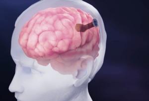 رقیب نورالینک رکورد ایمپلنت الکترود را در مغز شکست