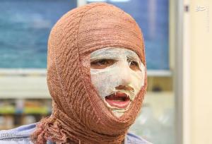 پوشش بیمه‌ای پانسمان‌های نوین سوختگی و مشکلات هزینه‌های درمان