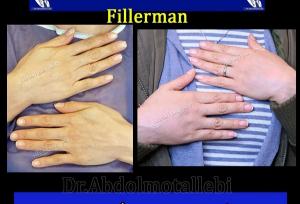 هزینه تزریق چربی به دست چقدر است؟