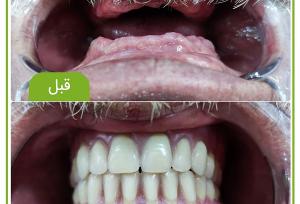 پروتز دندان چیست و چه انواعی دارد؟