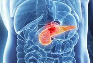 شناسایی علامت هشدار دهنده اولیه سرطان معروف به «قاتل خاموش»