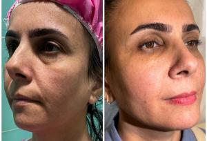 جوانسازی صورت به روش نوراریژن؛ روشی ترکیبی با ماندگاری بالا