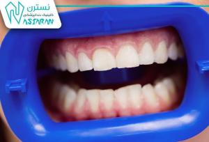 عفونت‌های لثه و پیامدهای انتخاب نادرست خدمات دندانپزشکی
