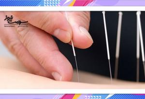 طب سوزنی؛ راهی نو برای تسکین کمردرد مزمن سالمندان